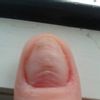 Problem z paznokciami na kciukach - 9712