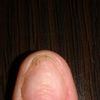 Problem z paznokciami na kciukach - 9713