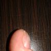 Problem z paznokciami na kciukach - 9714