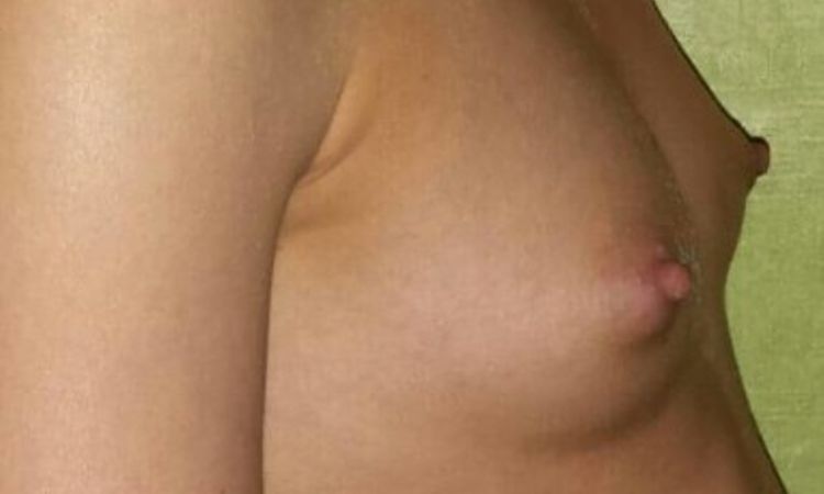 4 miesiące po operacji powiekszenia piersi - falowanie implantu - 9721