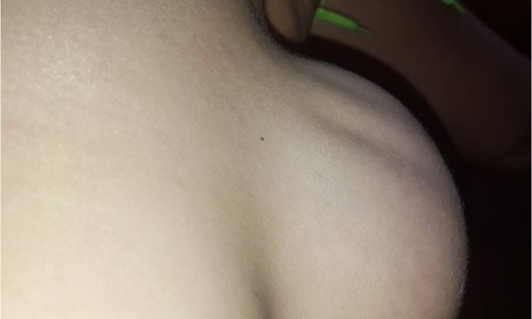 4 miesiące po operacji powiekszenia piersi - falowanie implantu - 9723