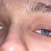 Asymetria oczu przy toksoplazmozie - 9735