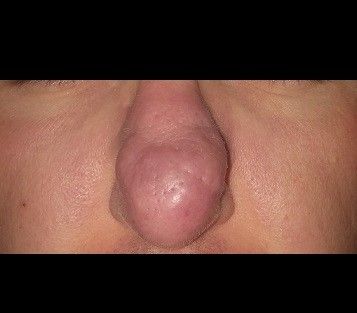 Rhinophyma - guzowatość nosa - szukam lekarza śląskie lub małopolskie - 9738