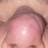 Rhinophyma - guzowatość nosa - szukam lekarza śląskie lub małopolskie - 9739