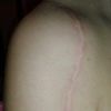 Pooperacyjna blizna na ramieniu - zniszczona skóra po laserze