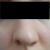 Nieudana operacja nosa - asymetria dziurek - 9822