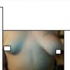 DUŻA asymetria piersi, augmentacja, waga do operacji - 9856