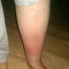 Spuchnięte nogi i ból oraz zaczerwienienie skóry - 9917