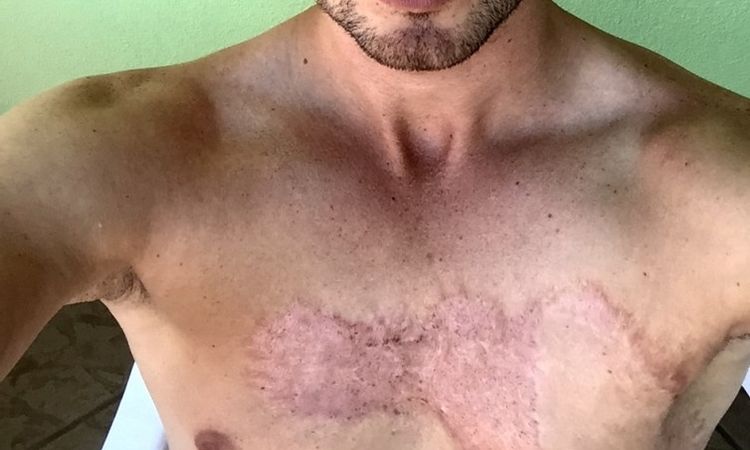 Jak poprawić wygląd blizny po oparzeniu? - 9939