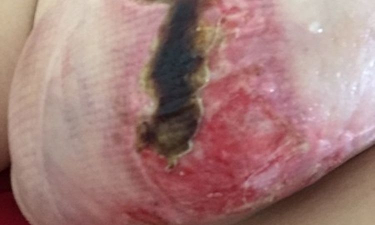 Redukcja biustu - brzydkie blizny i pękająca skóra - 9973
