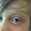 Jak postępować z blizną (kąsana) na twarzy sześciolatki - 9978