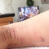 Nieestetyczne ślady po bandażowaniu nogi po skleroterapii - 9985