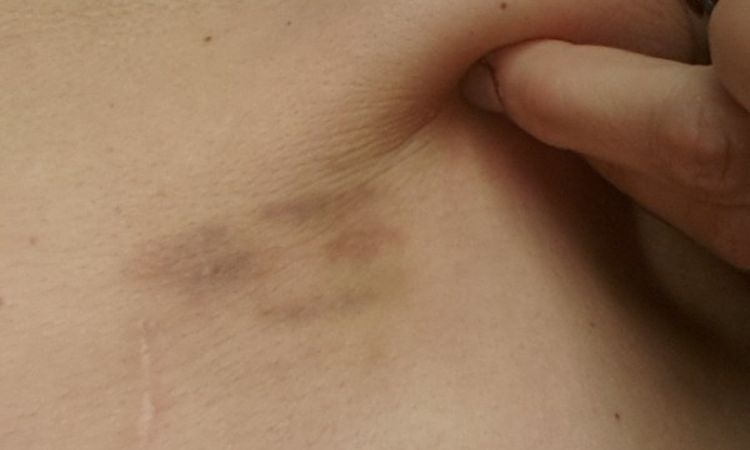 Blizna po plastyce brzucha - dlaczego się tworzą zakładki na biodrach? - 9998