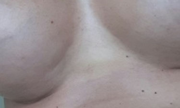 Duzyduży dyskomfort i ciągniecie piersi - 10005