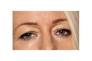 Blepharoplastyka laserem Co2 czy Plexr a niedoczynnosc tarczycy (Hashimoto) - 10007