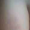 Matting po usuwaniu drobnych fioletowych żyłek
