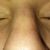 Korekta nosa po złamaniu - koszt zabiegu i możliwe efekty - 10025