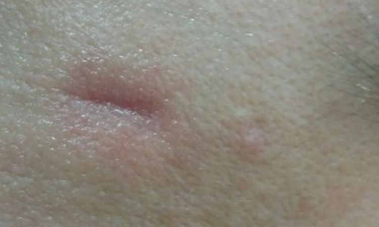 Zaczerwienienie 3 tygodnie po zabiegu laserem frakcyjnym - 10030