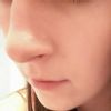 Zmiany skórne na nosie - jak usunąć? - 10078