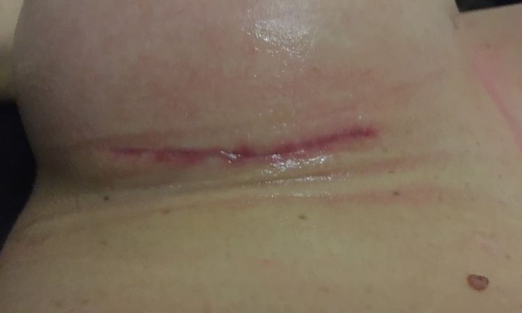 Miesiąc po zabiegu - słabo gojąca się rana i białe nitki - 10084