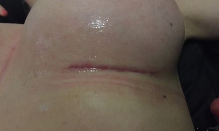 Miesiąc po zabiegu - słabo gojąca się rana i białe nitki - 10085