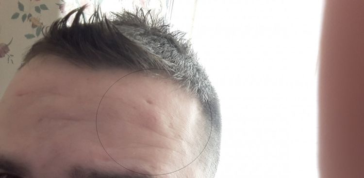 Guz podskórny umiejscowiony na czole.