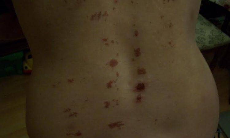 Rany, blizny po laserze IPL - plecy - szukam lekarza, który rozwiąże mój problem - 10190