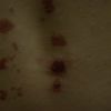Rany, blizny po laserze IPL - plecy - szukam lekarza, który rozwiąże mój problem