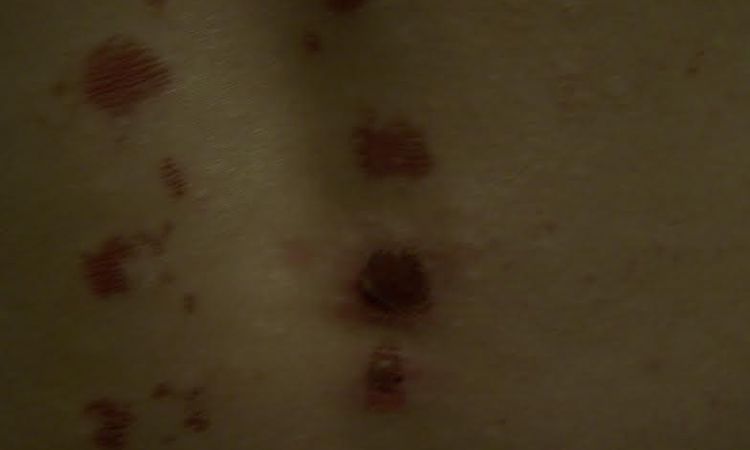 Rany, blizny po laserze IPL - plecy - szukam lekarza, który rozwiąże mój problem - 10191