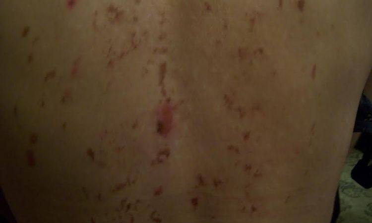 Rany, blizny po laserze IPL - plecy - szukam lekarza, który rozwiąże mój problem - 10192