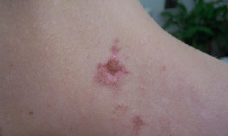 Rany, blizny po laserze IPL - plecy - szukam lekarza, który rozwiąże mój problem - 10193