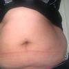 Brzuszek po porodzie - czy starczy sama liposukcja?