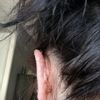 Fałda skóry na lewym uchu po korekcji uszu