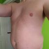 Liposukcja brzucha