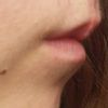 Asymetria ust po usunięciu znamienia  - 10260