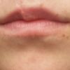 Asymetria ust po usunięciu znamienia  - 10261
