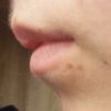 Asymetria ust po usunięciu znamienia  - 10262