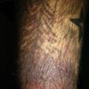 Zapalenie alergiczne skóry w obrębie tatuażu - 10292