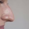 Operacja plastyczna długiego nosa 