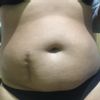Liposukcja + korekcja blizny - brzuch