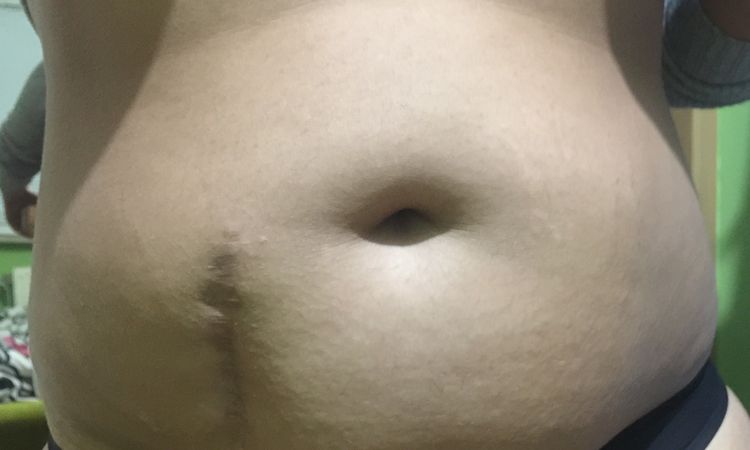 Liposukcja + korekcja blizny - brzuch - 10346