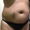 Liposukcja + korekcja blizny - brzuch