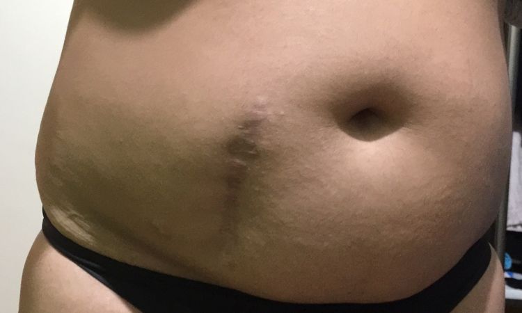 Liposukcja + korekcja blizny - brzuch - 10347