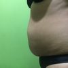 Liposukcja + korekcja blizny - brzuch