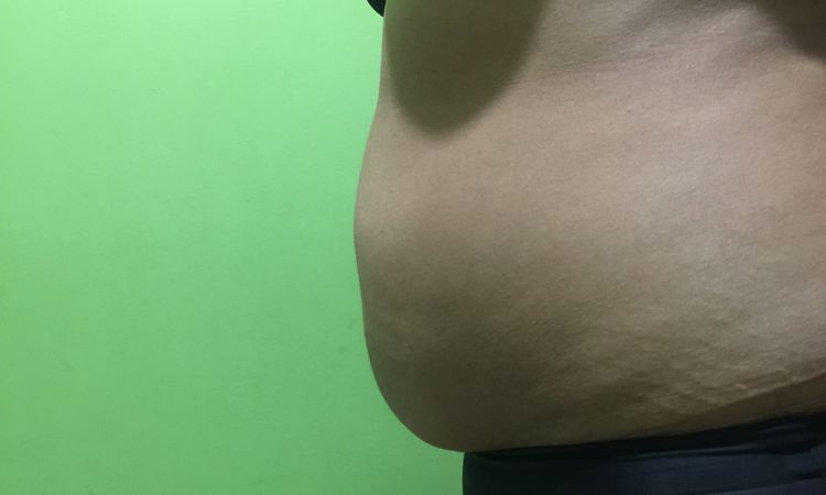 Liposukcja + korekcja blizny - brzuch - 10348