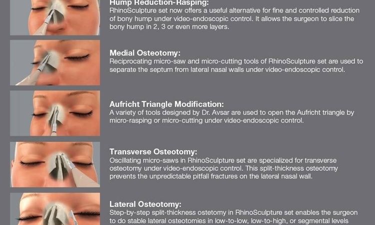 Micro-rhinoplasty (RhinoSculpture) - 10362