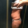 Odsysanie tłuszczu z brzucha - wybór lekarza, cena, planowanie ciąży