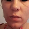 Opadająca skóra twarzy w wieku 33 lat - jak poprawić owal twarzy i wygląd skóry  - 10383