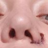 Kilkukrotnie nieudana operacja nosa, korekta skrzydelka oraz brak chrzastki. Pom - 10433
