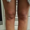 Liposukcja łydki i okolice kolan